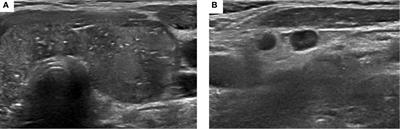 Case Report and Review of Literature: Thyroid Metastases From Breast Carcinoma